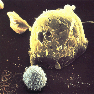 Клетка иммунной системы (на фотографии обозначена голубым цветом) атакует раковую клетку.
